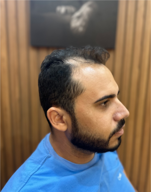 Prótese Capilar - Hercules Oliveira em Fortaleza