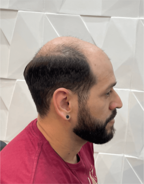 Prótese Capilar - Hercules Oliveira em Fortaleza