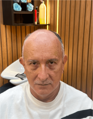 Prótese Capilar - Hercules Oliveira em Fortaleza