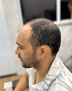 Prótese Capilar - Hercules Oliveira em Fortaleza